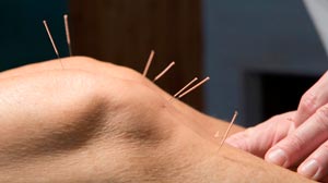 Bild på rygg under akupunkturbehandling